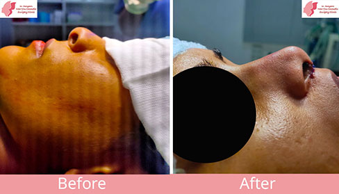 Rhinoplasty